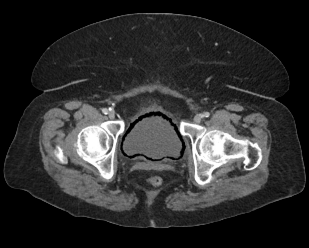 CT Case 015 CT abdomen 01