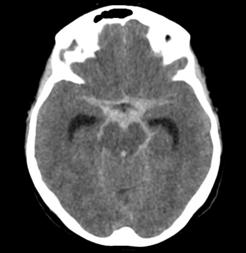 CT Case 016 CT brain 01