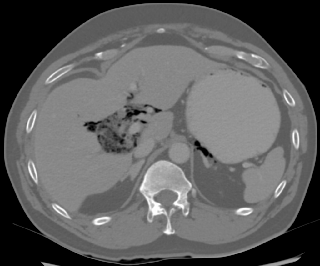 Case 010 CT abdomen 01