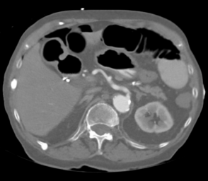 Case 012 CT abdomen 1