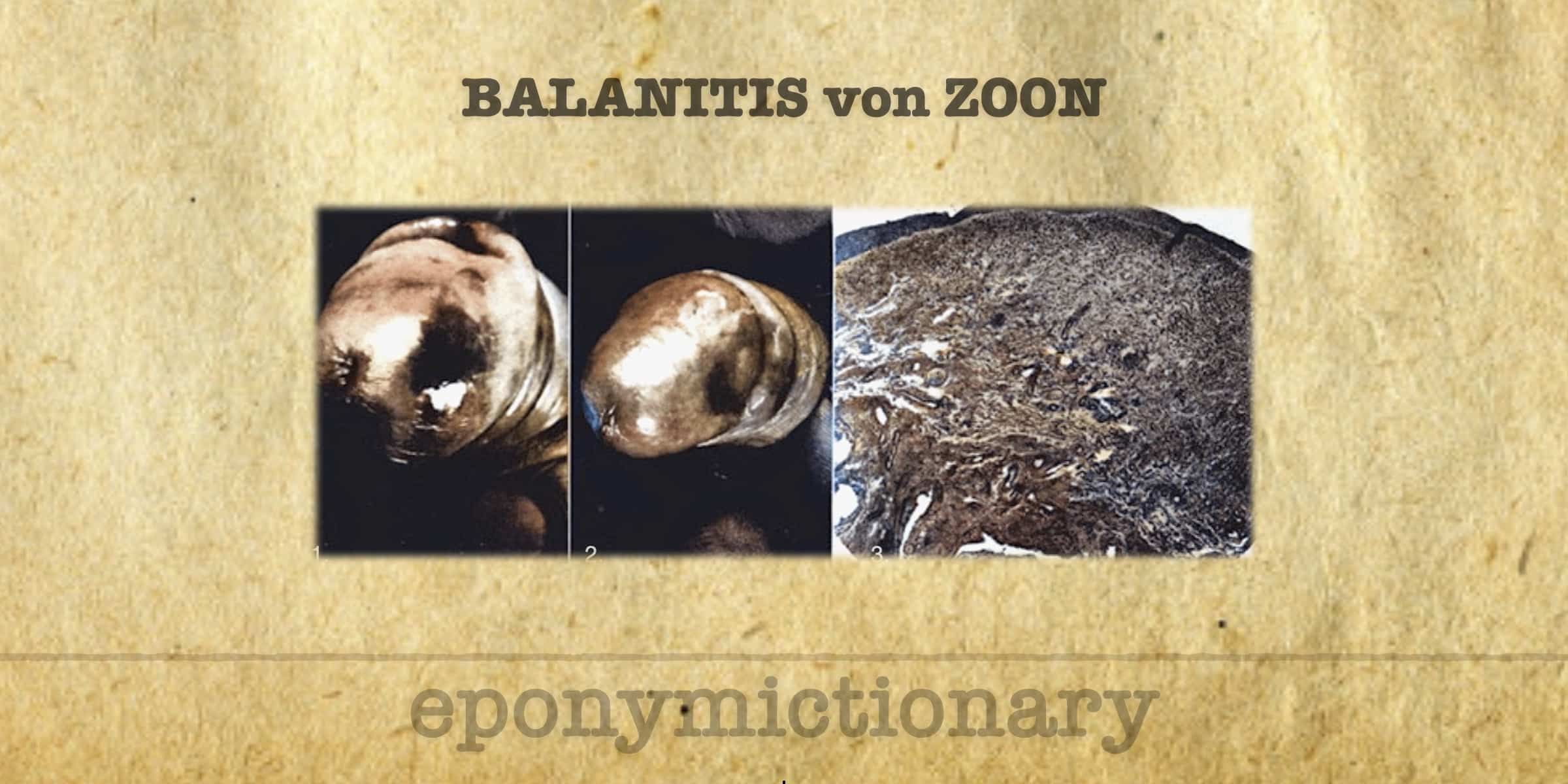 Zoon Balanitis LITFL Medical Eponym Library Zoon Balanitis LITFL Medical Eponym Library