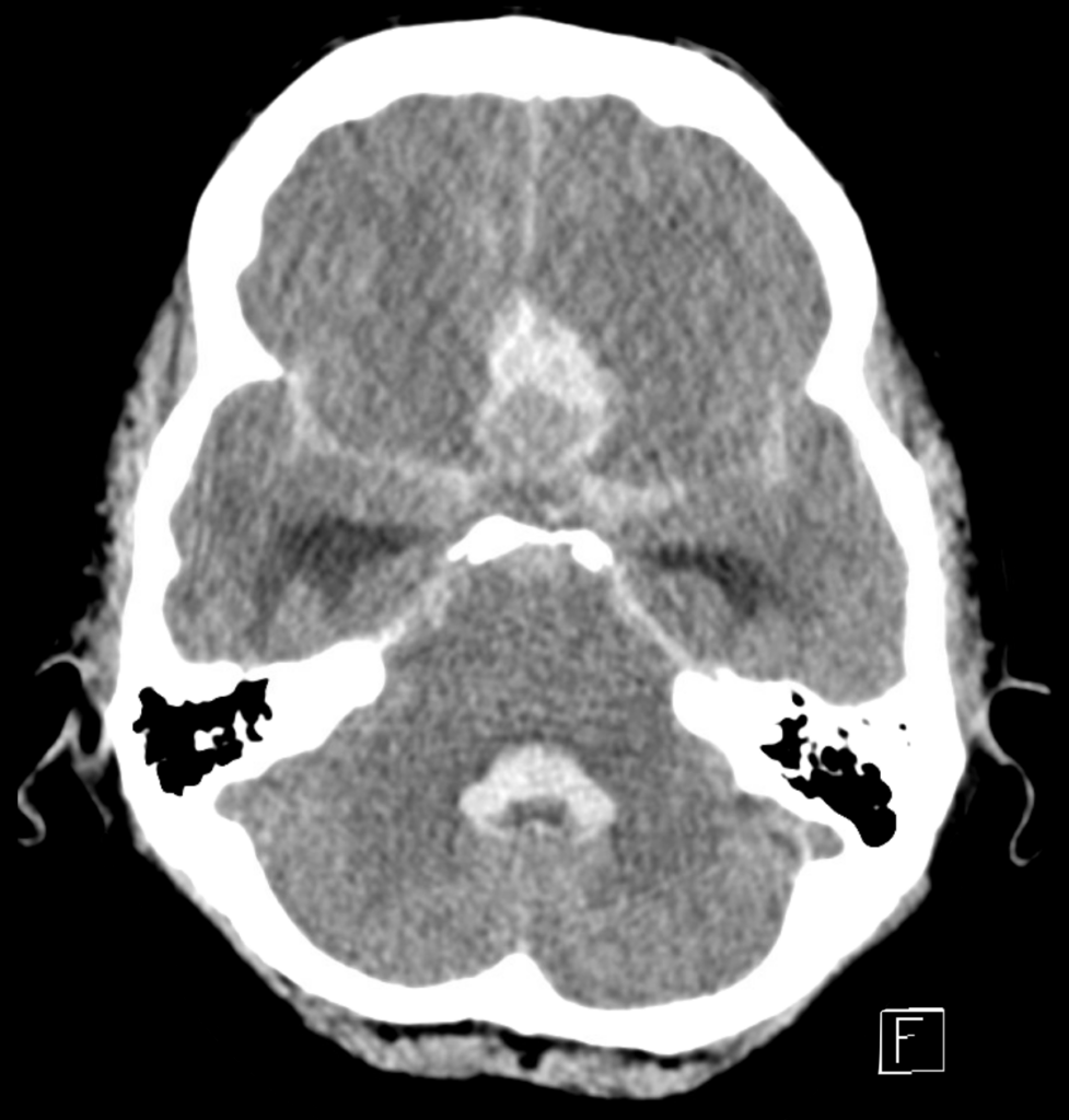 CT Case 018 CT head 01