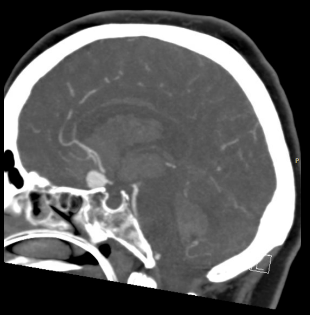 CT Case 018 CTA