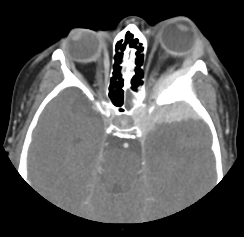 CT Case 019 CT orbits 01