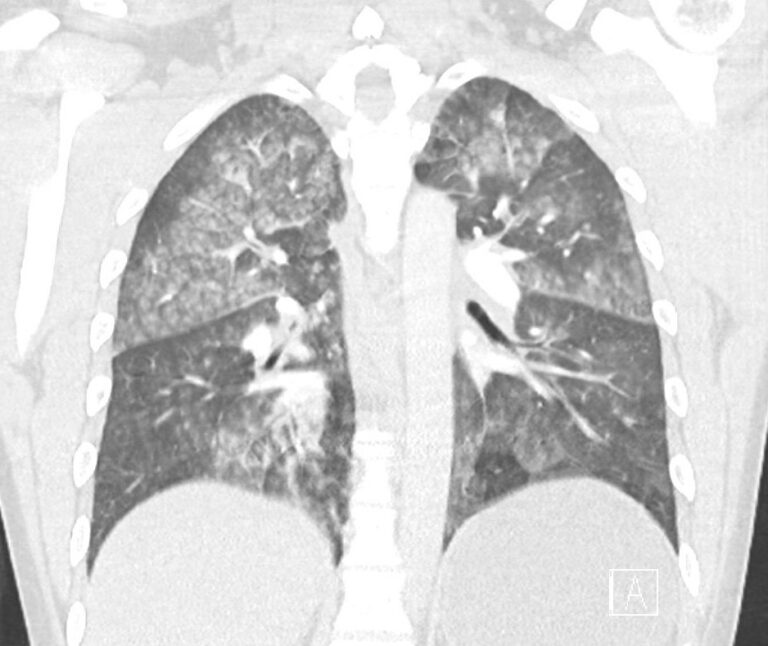 CT Case 028 • LITFL • CT scan interpretation