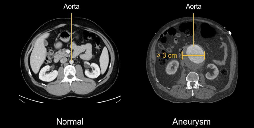 CT abdomen AAA 1