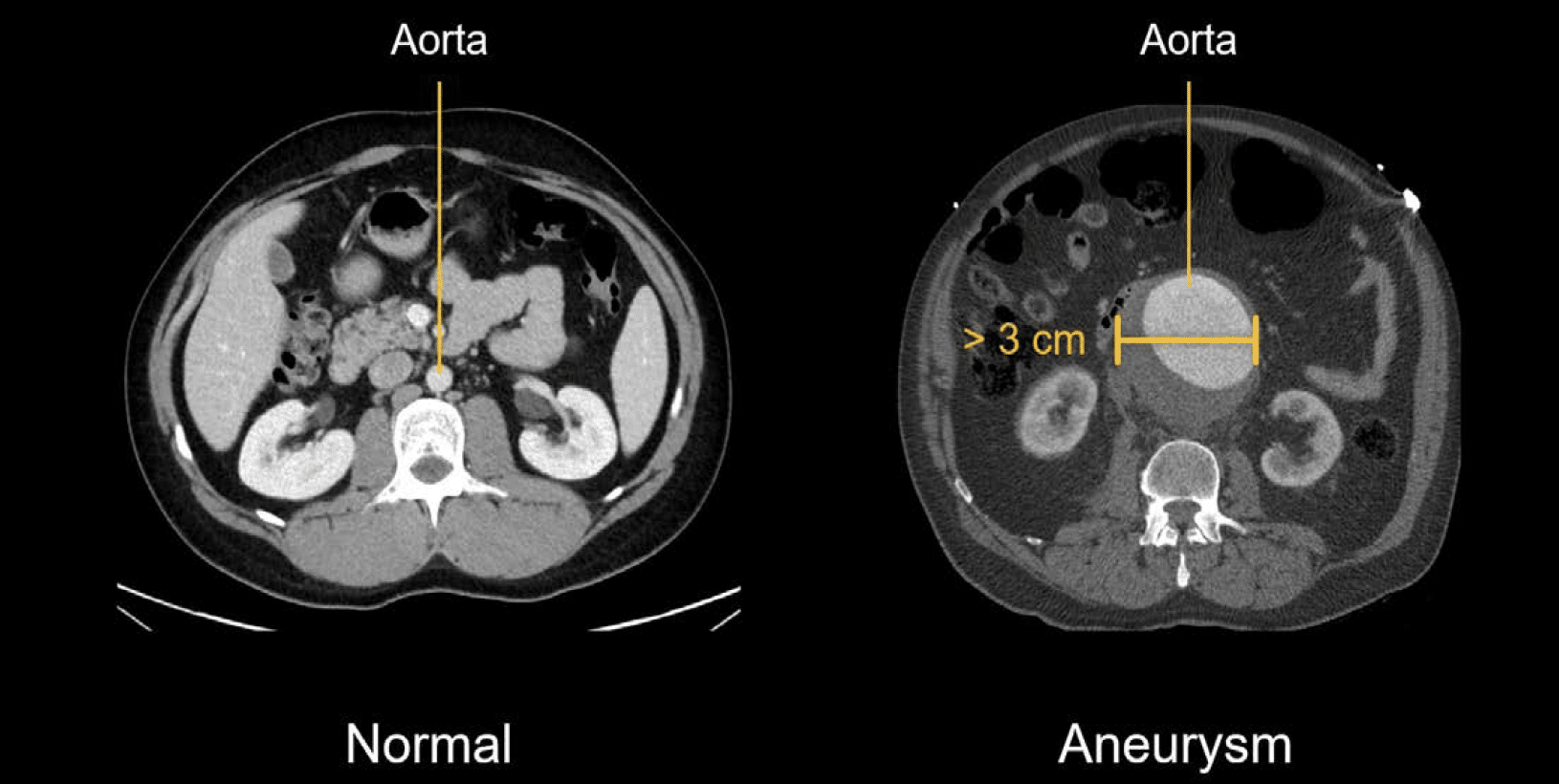 Abdominal CT: aortic aneurysm • LITFL • Radiology Library