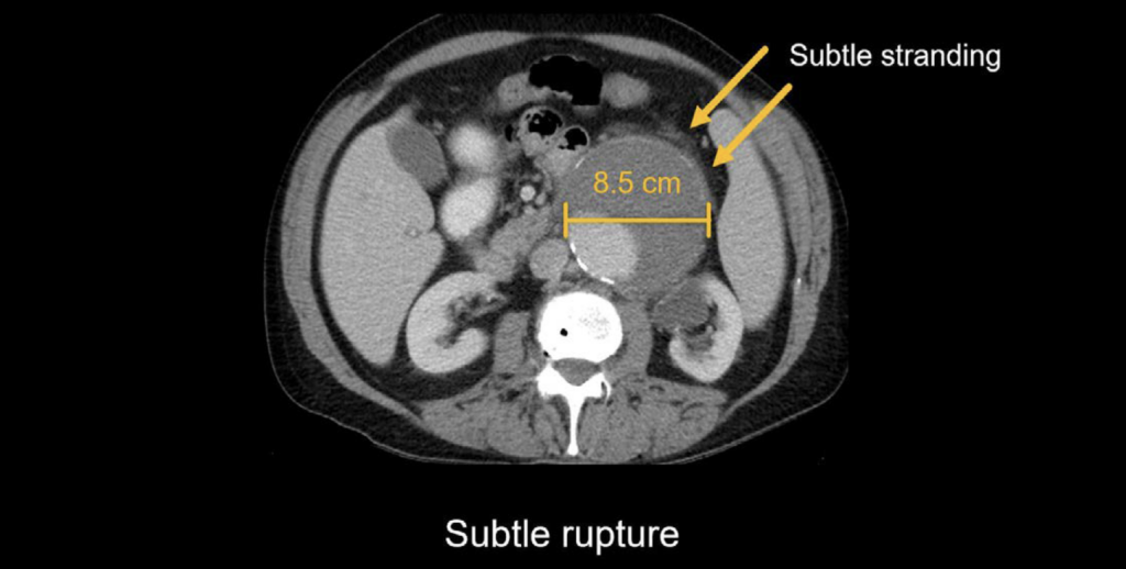 Abdominal CT: Aortic Aneurysm • LITFL • Radiology Library