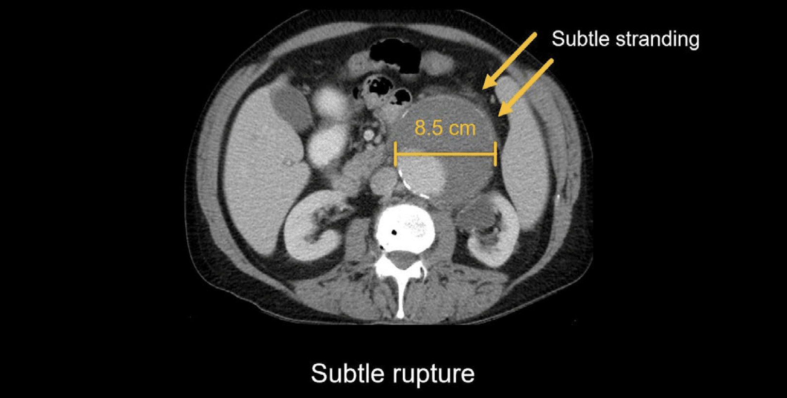 Abdominal CT Aortic Aneurysm LITFL Radiology Library abdominal-ct-aortic-aneurysm-litfl-radiology-library