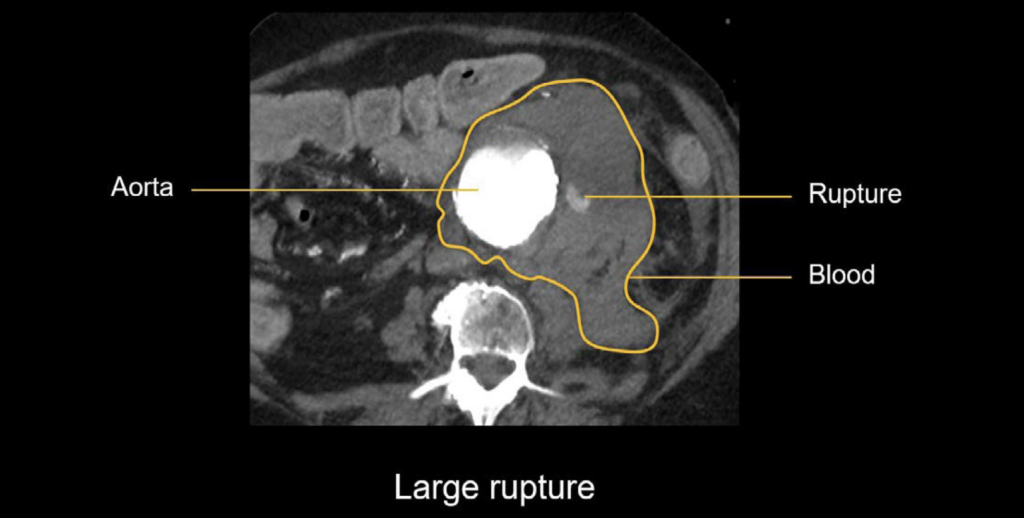 Abdominal CT: aortic aneurysm • LITFL • Radiology Library