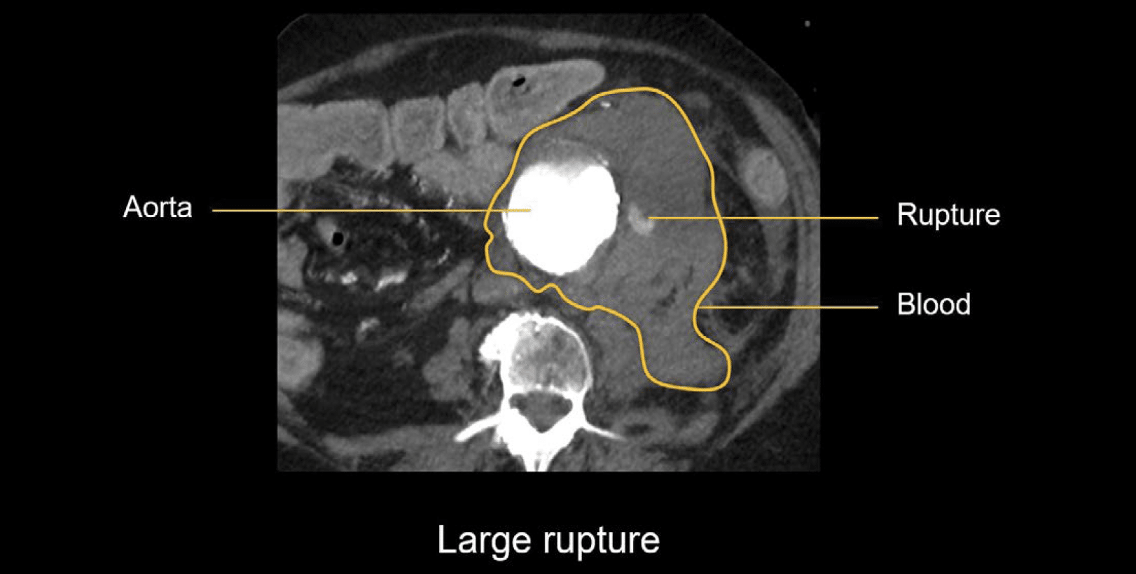 Abdominal CT Aortic Aneurysm LITFL Radiology Library