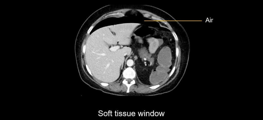 abdominal-ct-bowel-perforation-litfl-radiology-library