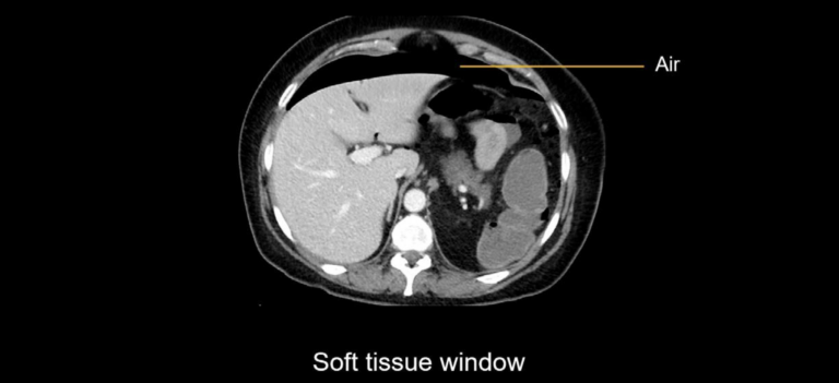 Abdominal CT Bowel Perforation LITFL Radiology Library abdominal-ct-bowel-perforation-litfl-radiology-library