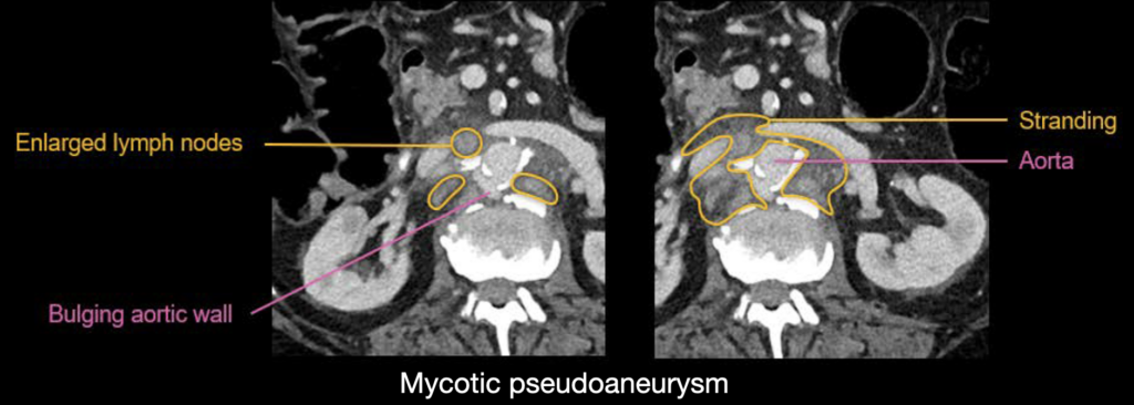 CT abdomen Mycotic pseudoaneurysm