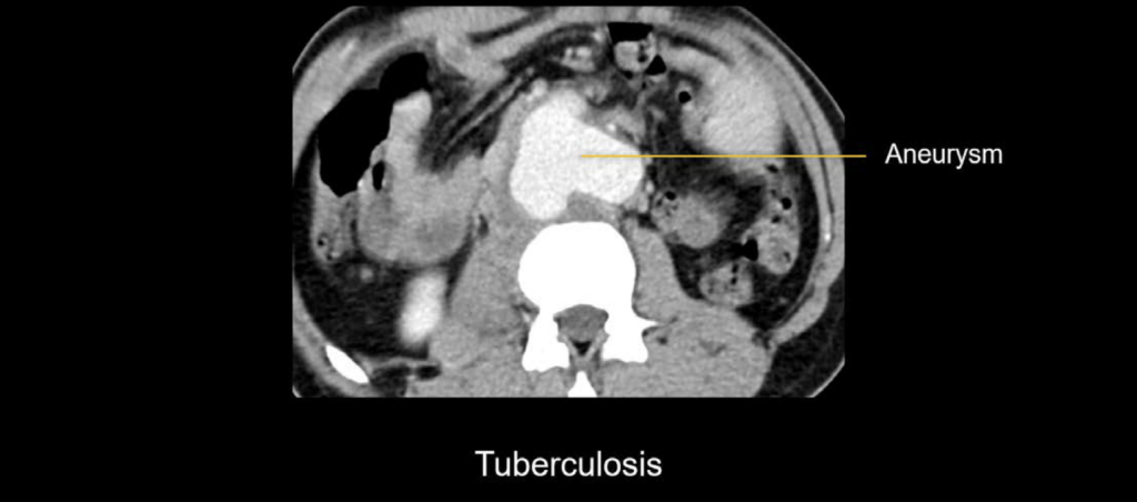 CT abdomen Mycotic pseudoaneurysm TB