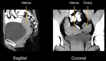 Abdominal CT: genitourinary system • LITFL • Radiology