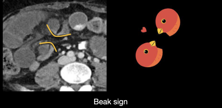 Abdominal CT Closed Loop LITFL Radiology Library abdominal-ct-closed-loop-litfl-radiology-library