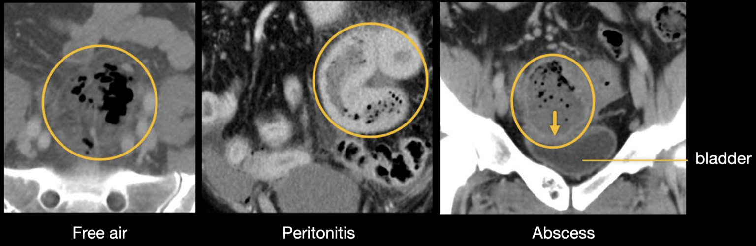 Abdominal CT diverticulitis • LITFL • Radiology Library