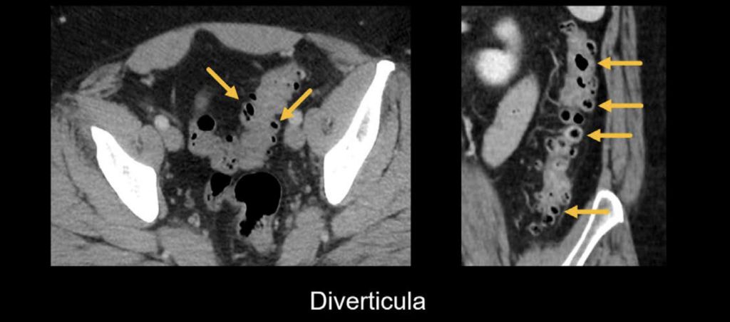 CT abdomen diverticula disease