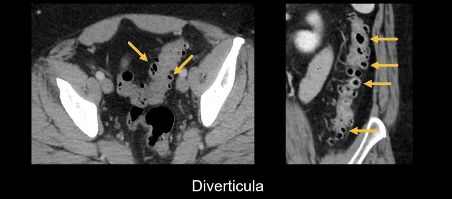 Abdominal CT Diverticulitis LITFL Radiology Library abdominal-ct-diverticulitis-litfl-radiology-library