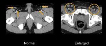Abdominal CT: lymph nodes • LITFL • Radiology Library