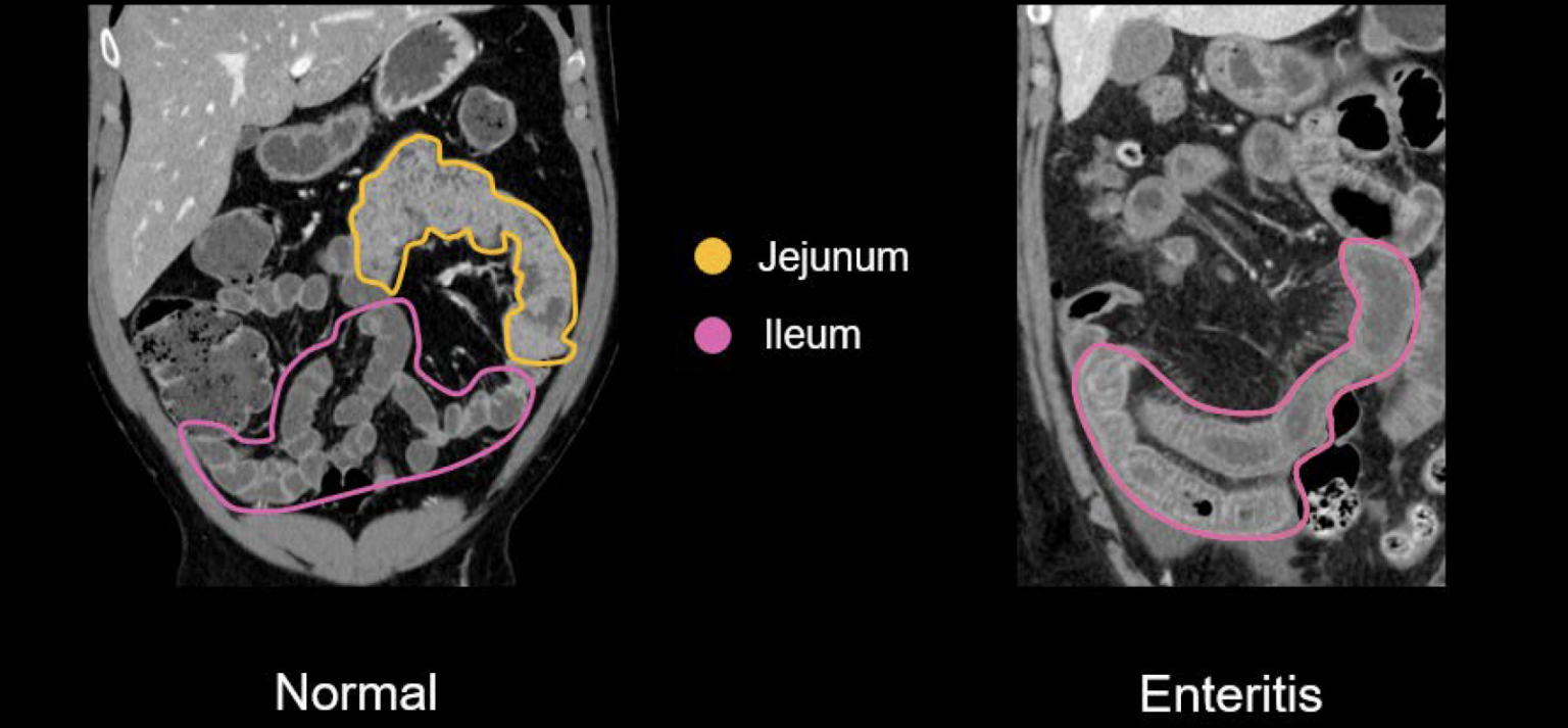Abdominal CT enteritis and colitis • LITFL • Radiology Library