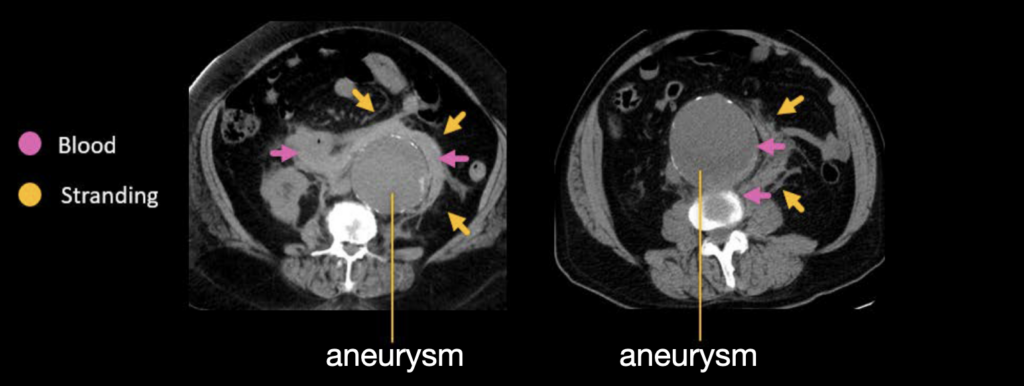 CT abdomen incidental AAA