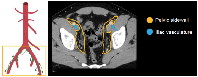 Abdominal Ct Lymph Nodes • Litfl • Radiology Library