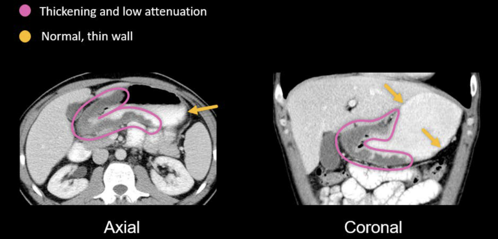 abdominal-ct-peptic-ulcer-disease-litfl-radiology-library