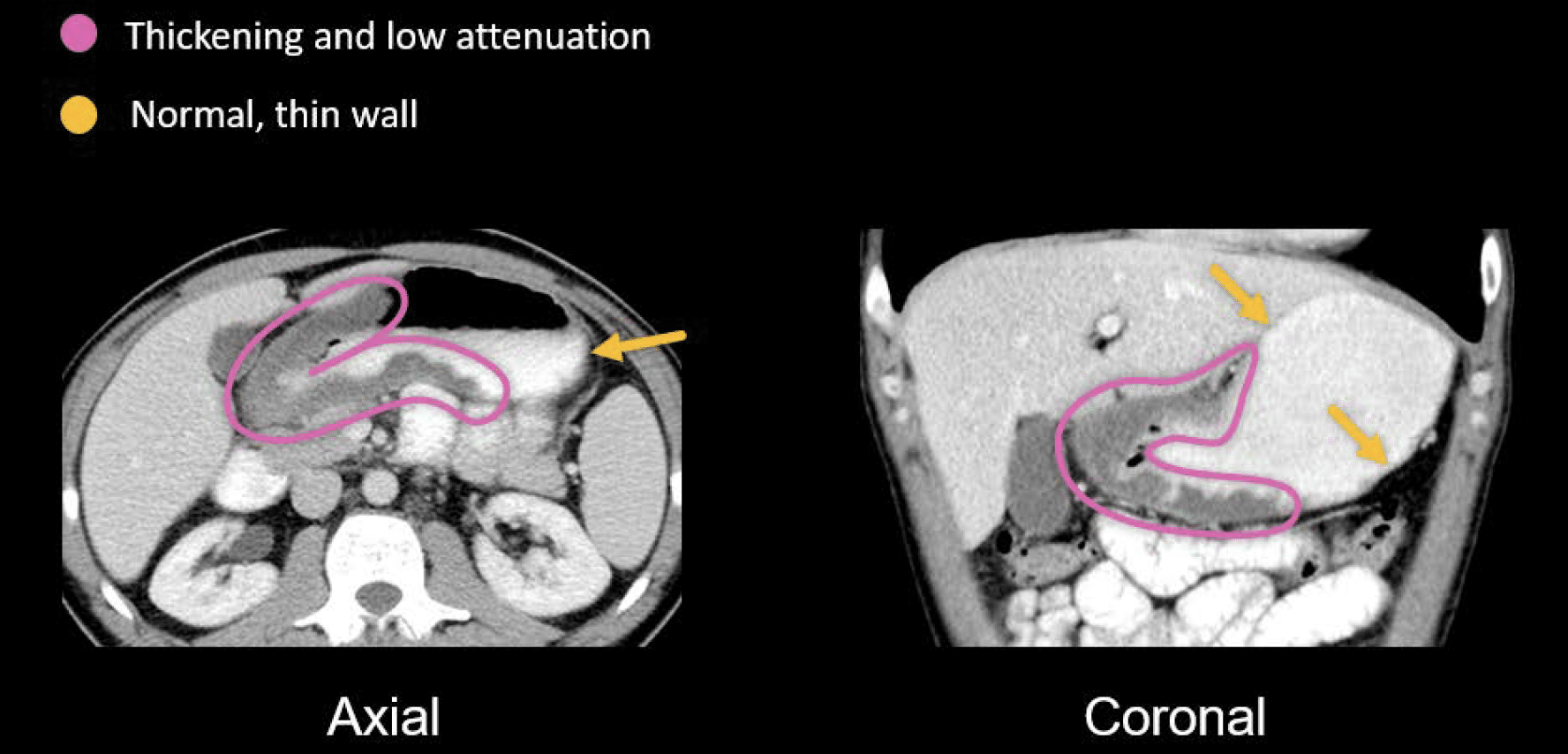 abdominal-ct-peptic-ulcer-disease-litfl-radiology-library