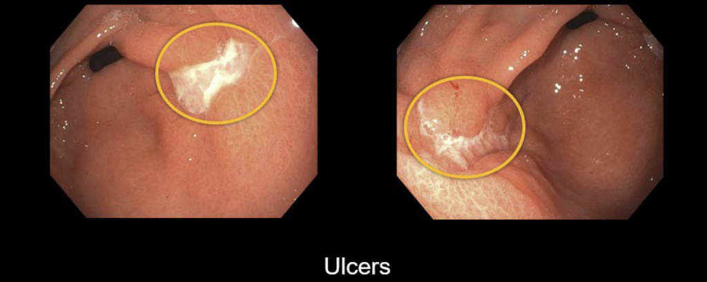 CT abdomen peptic ulcer disease 2