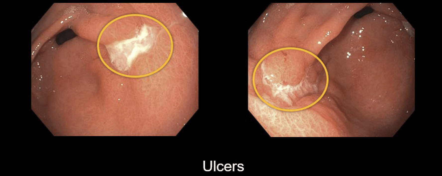 gastric ulcer