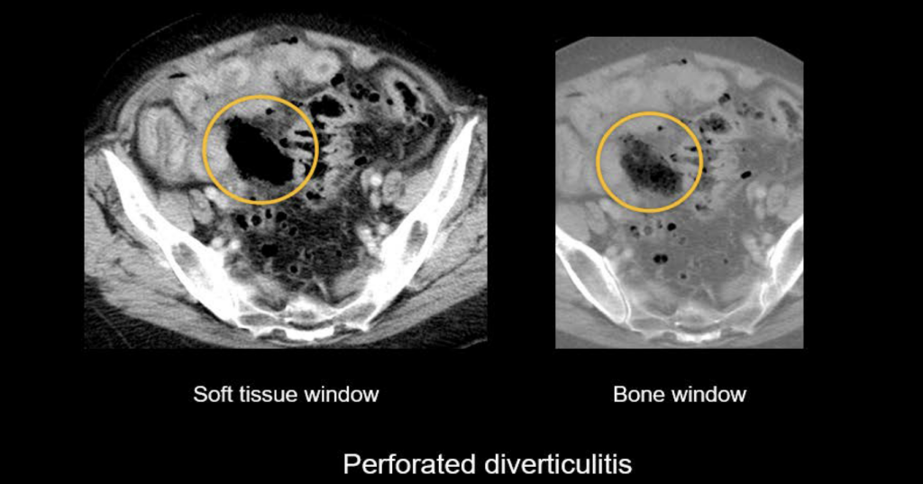 Abdominal CT Bowel Perforation LITFL Radiology Library