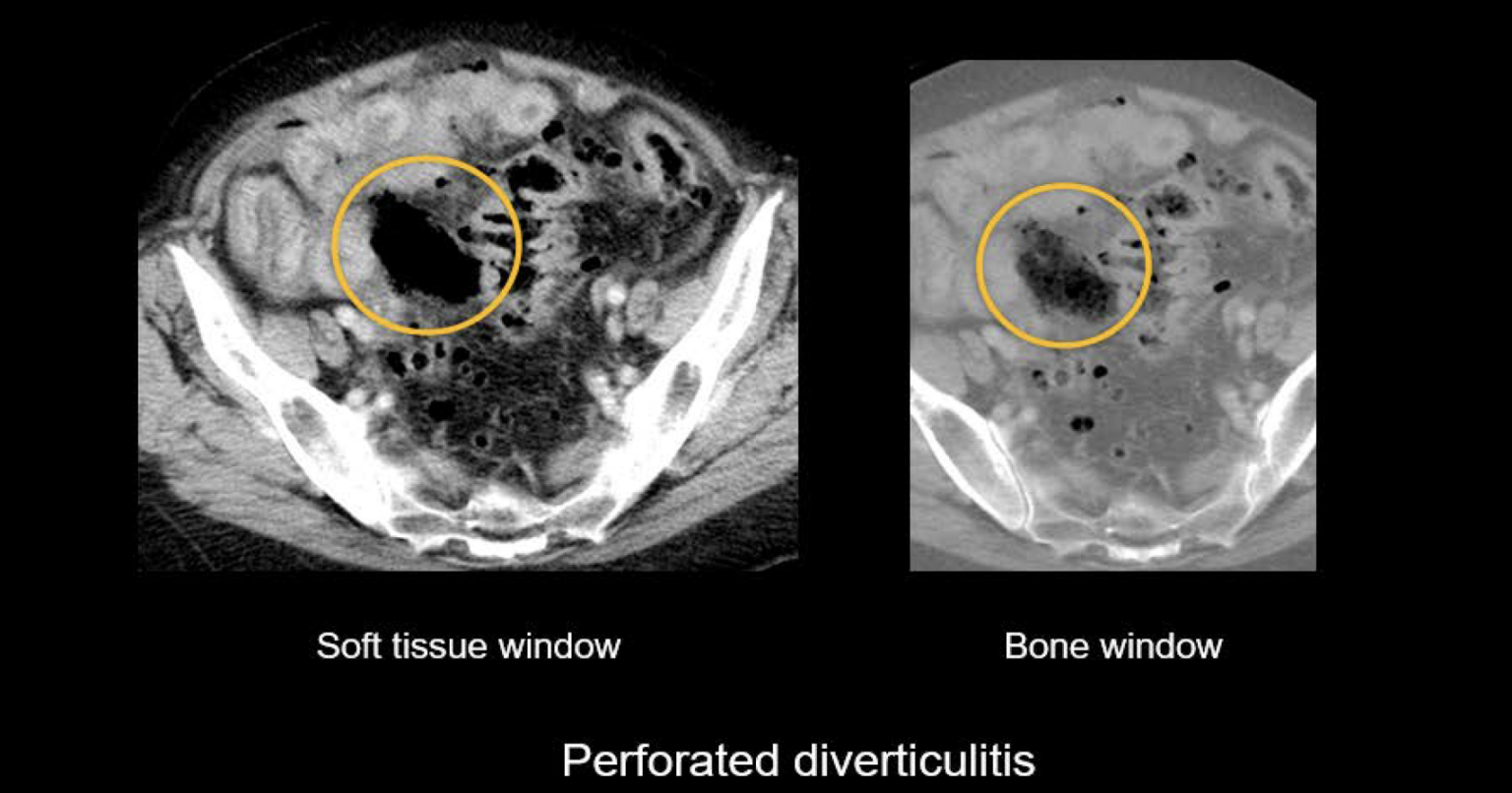 Abdominal ct bowel perforation litfl radiology library