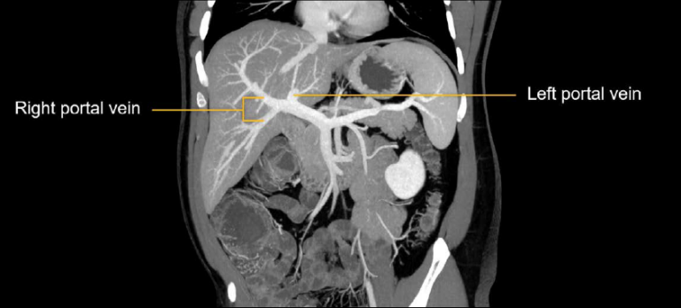 Abdominal CT Abdominal Veins LITFL Radiology Library abdominal-ct-abdominal-veins-litfl-radiology-library