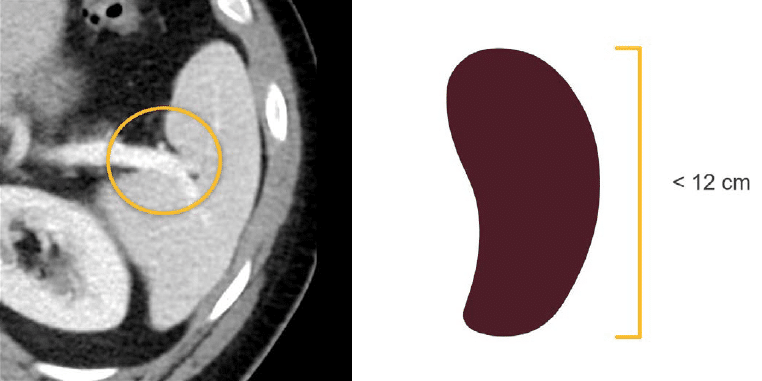 Abdominal Ct Spleen And Adrenal Glands • Litfl • Radiology