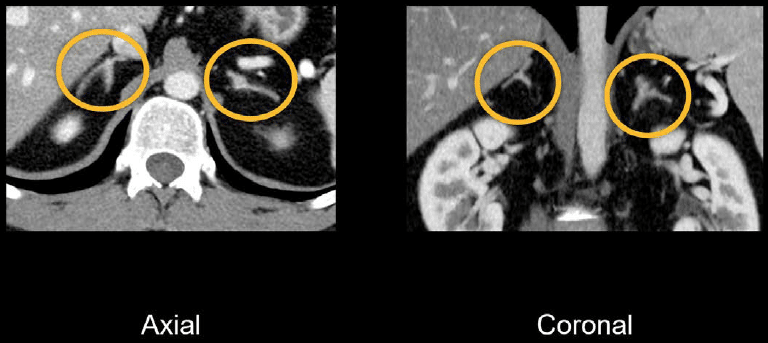 Abdominal Ct Spleen And Adrenal Glands • Litfl • Radiology