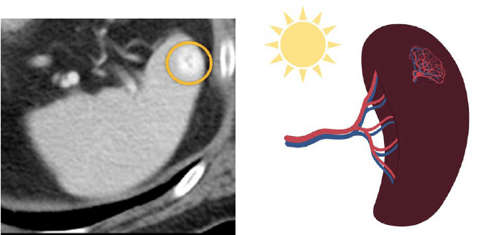 CT abdomen spleen hemangioma