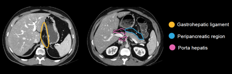 Abdominal CT: lymph nodes • LITFL • Radiology Library