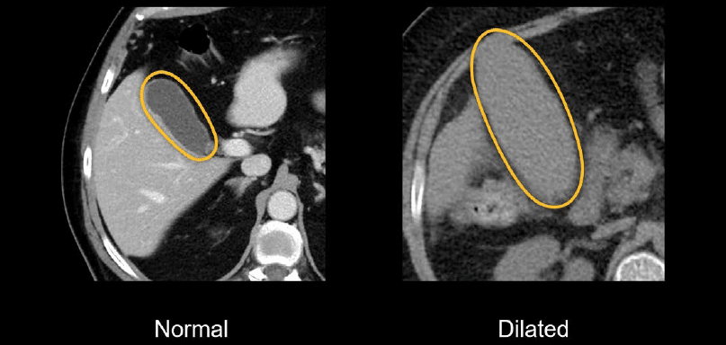 Cholecystitis