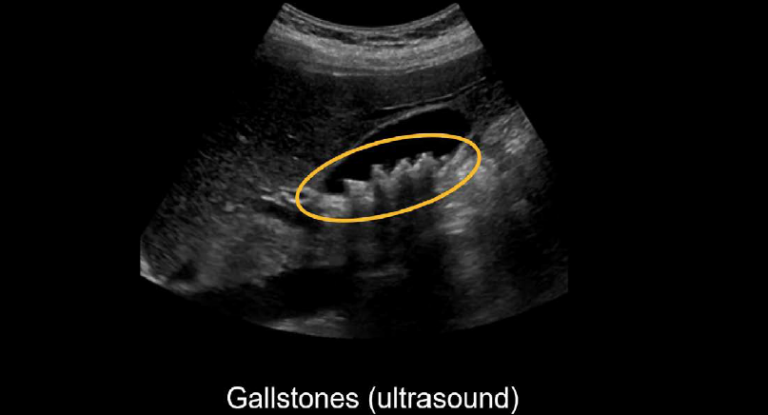 Abdominal Ct Cholecystitis • Litfl • Radiology Library