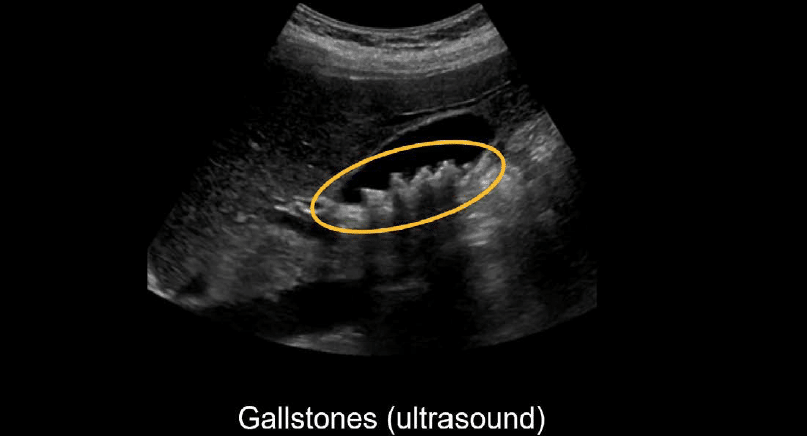 cholelithiasis ultrasound