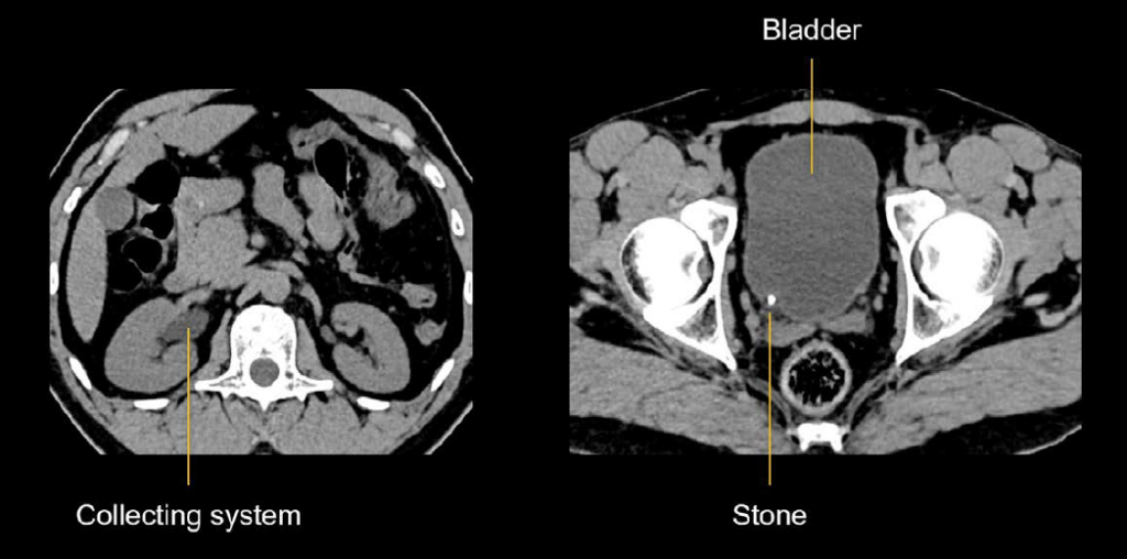 Renal stone VUJ CT non con