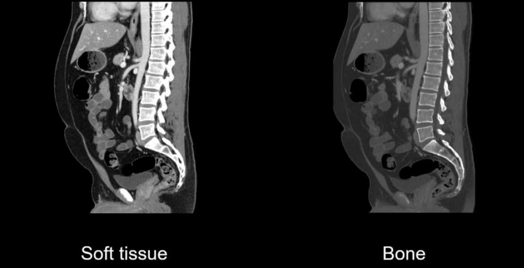 Abdominal CT bone window