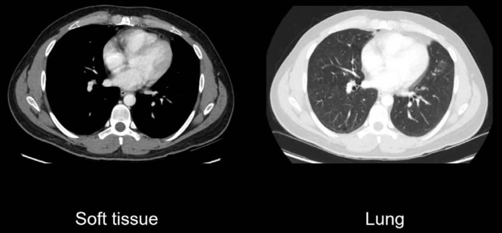 Abdominal CT lung window