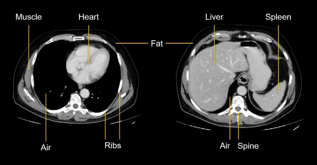 Abdominal CT Basics LITFL Radiology Library