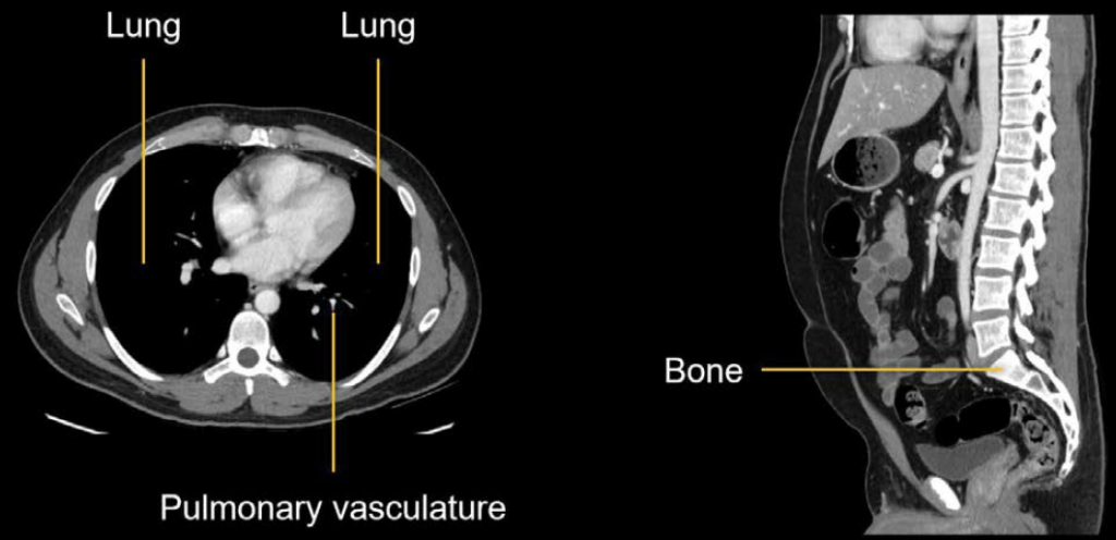 Abdominal CT soft tissue window poor for lung and bone