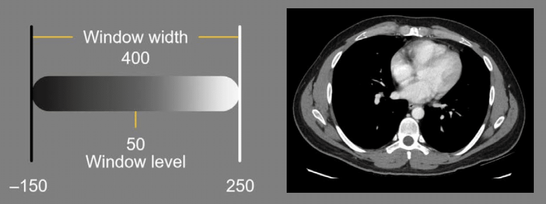 abdominal-ct-windows-advanced-litfl-radiology-library