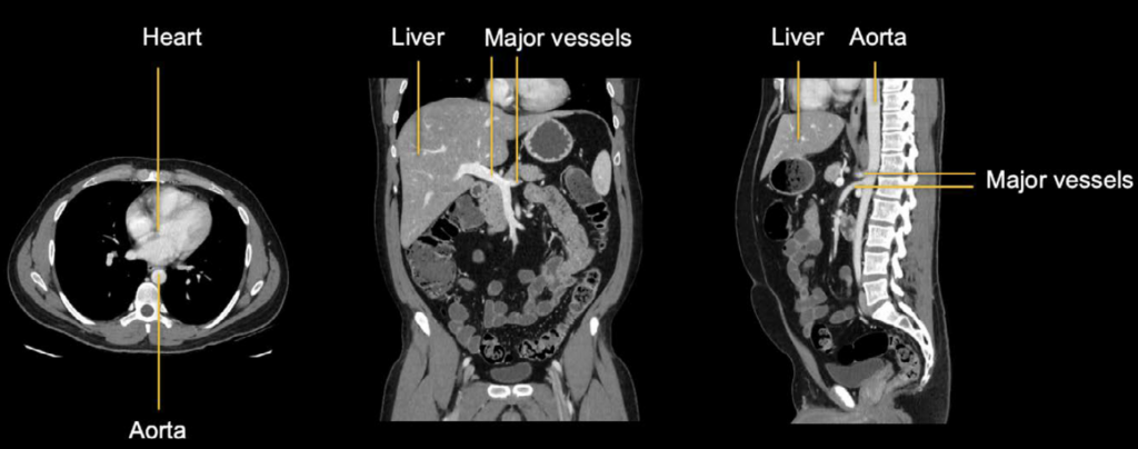 Abdominal CT. Soft tissue window. Axial, coronal, Sagittal