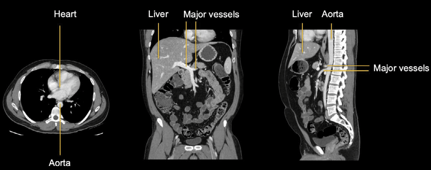 Abdominal Ct Windows Basics • Litfl • Radiology Library